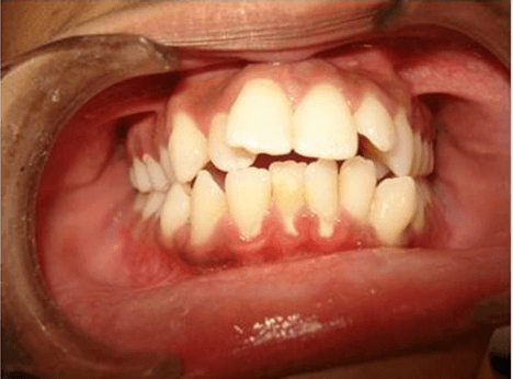 Before treatment - Patient 1